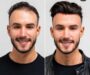 Benefits of Choosing Hair Transplant Surgery
